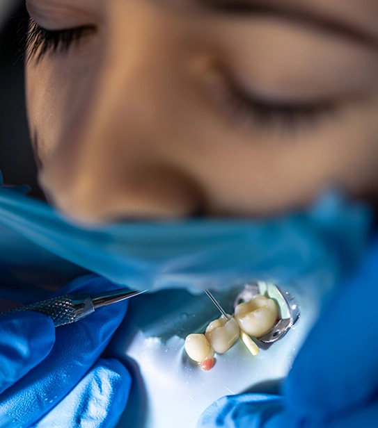 Dental Inlay and Onlay Treatment Procedure Close-Up