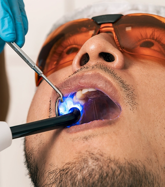 Dentist using blue curing light to harden composite dental filling during cavity treatment