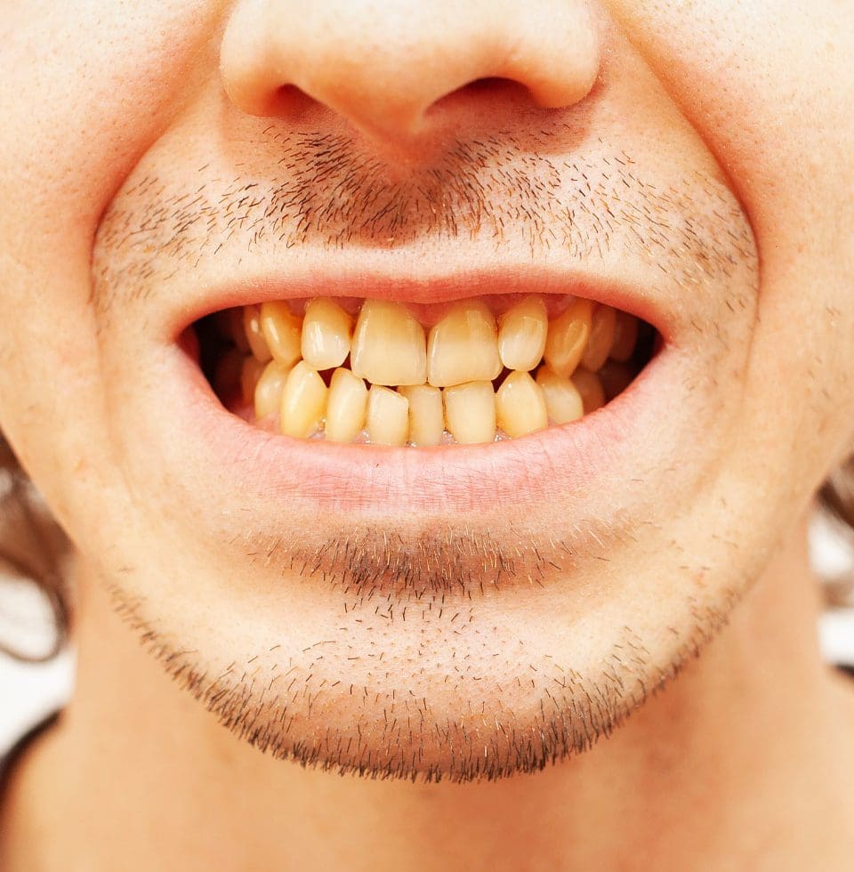 Discoloured Teeth Treatment London