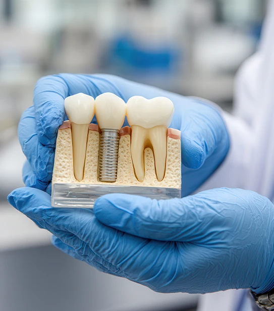Dental implant model comparison showing artificial tooth replacement versus natural teeth structure in a clinical setting.