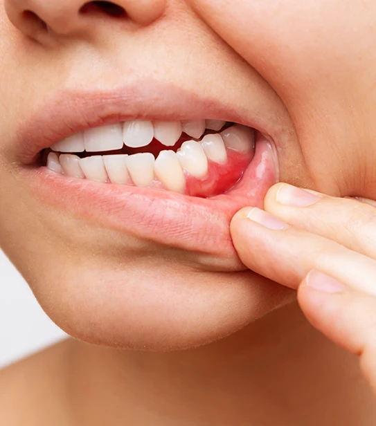 Visual signs of gum disease and gingivitis inflammation with bleeding gums and redness in a young adult.